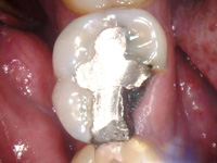 IntraOral picture