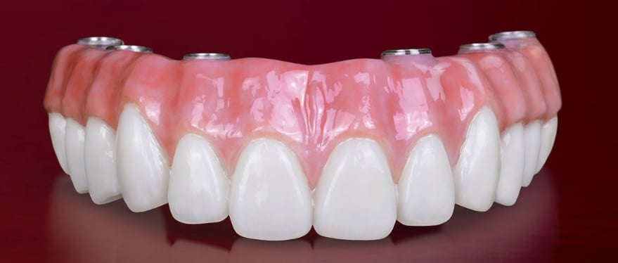 Implant Prothesis Implant Prothesis
