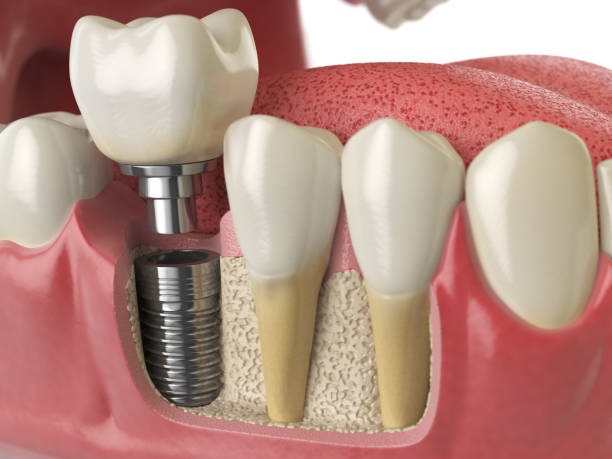 Implant Services
